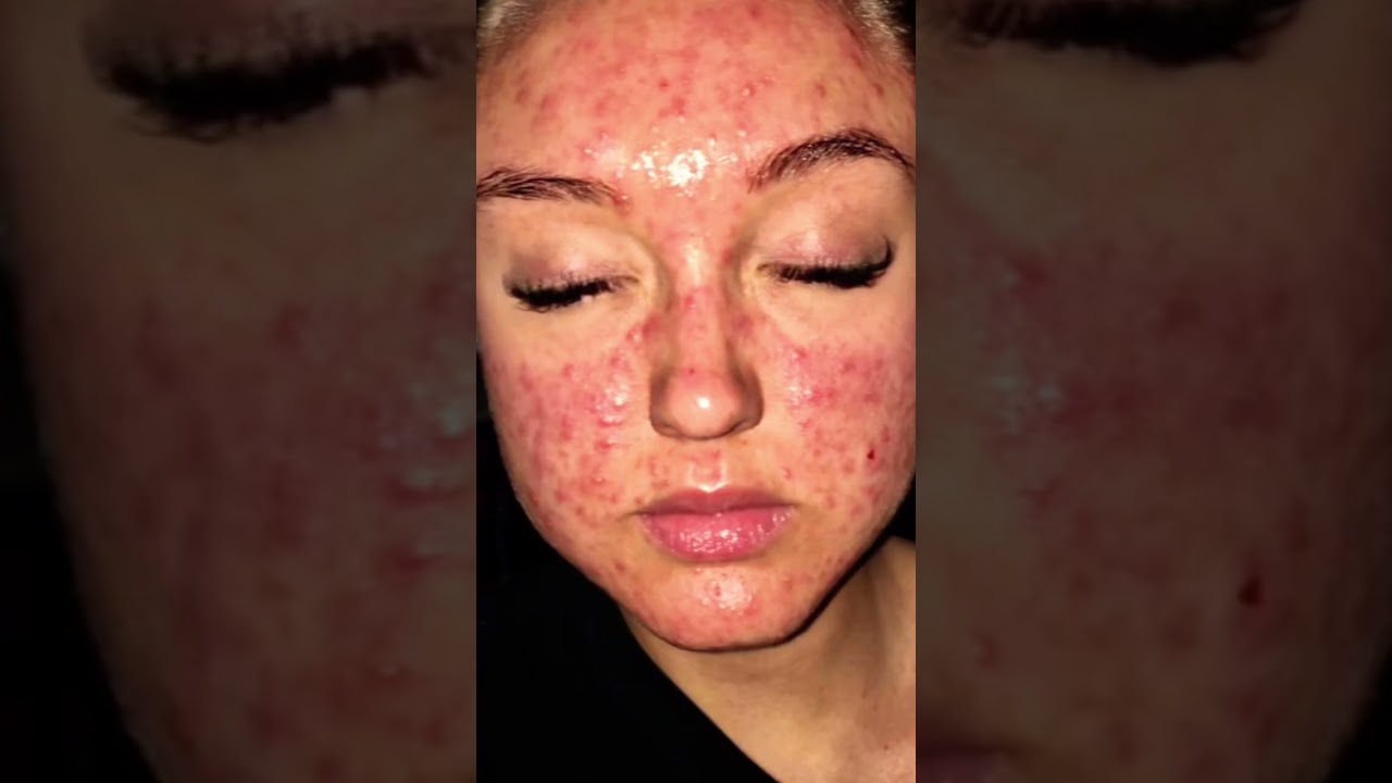 youtube placeholder image